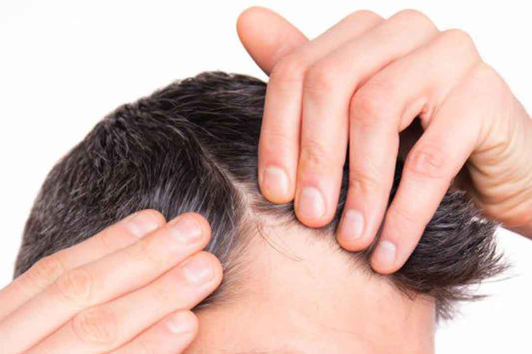 Injertocapilar Injerto capilar